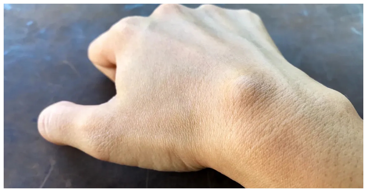 গঠন, বৃদ্ধির হার, উপসর্গ, ইত্যাদি বিবেচনা করে শনাক্ত করা যায় ফোলাভাব বিপজ্জনক কিনা। ছবি: হেলথলাইন